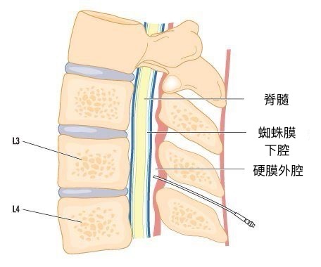 硬膜外注射 硬膜外注射