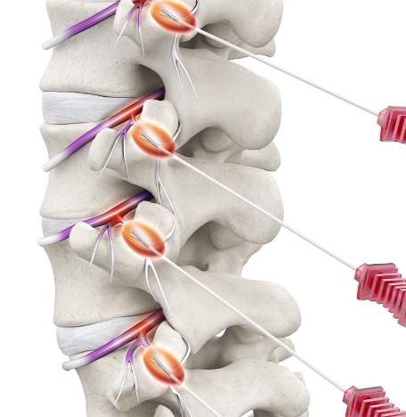 高頻熱凝療法(Radiofrequency Ablation, RFA) 高頻熱凝療法(Radiofrequency Ablation, RFA)
