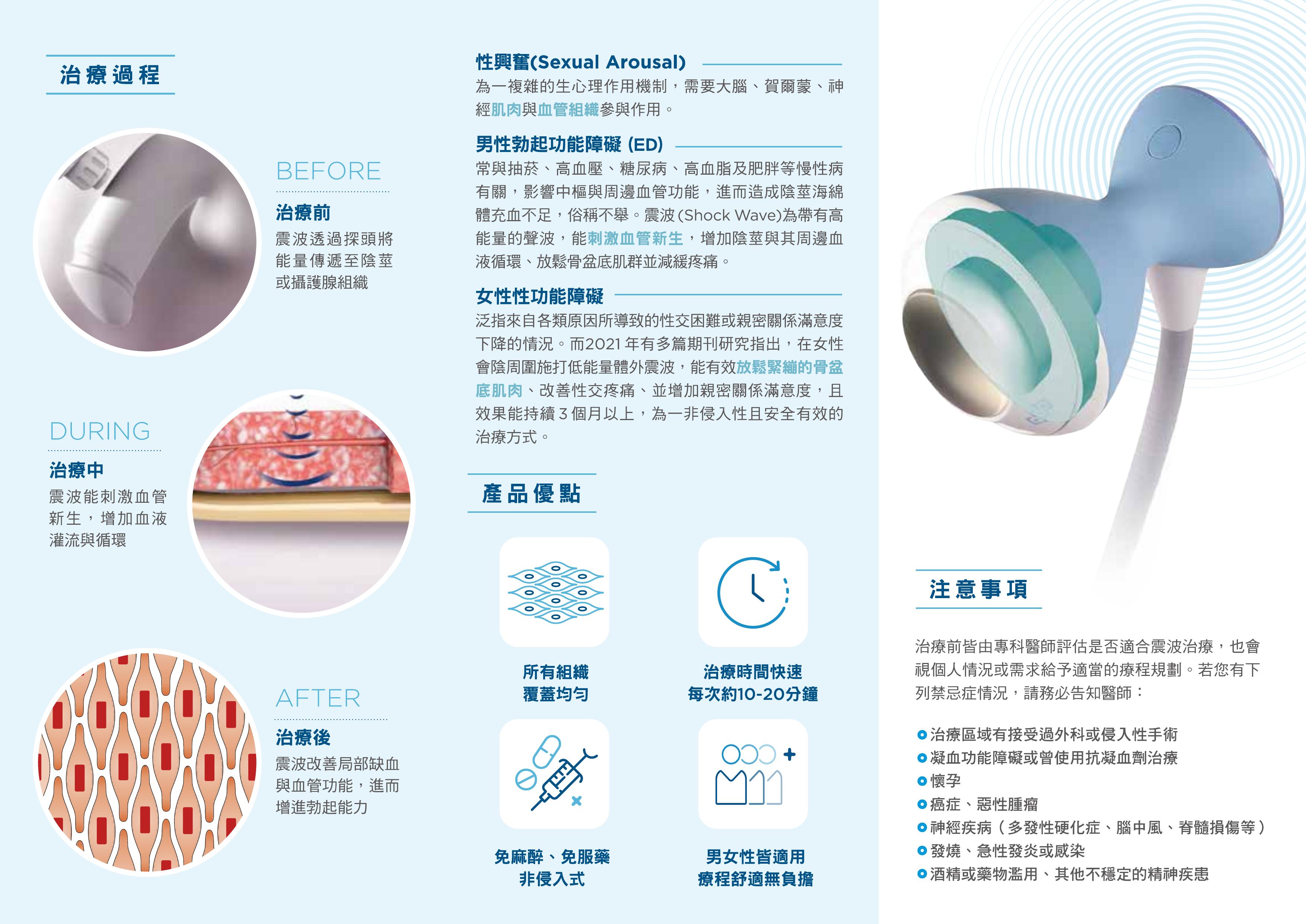 ED,性功能障礙,勃起功能障礙,聚焦式體外震波 ED,性功能障礙,勃起功能障礙,聚焦式體外震波